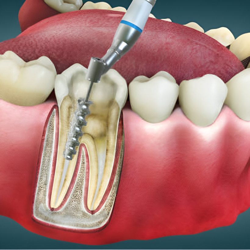 endodontia-o-que-e